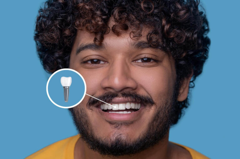 Vou Fazer um Implante e o Dentista Disse que Preciso de Enxerto – Devo Confiar?
